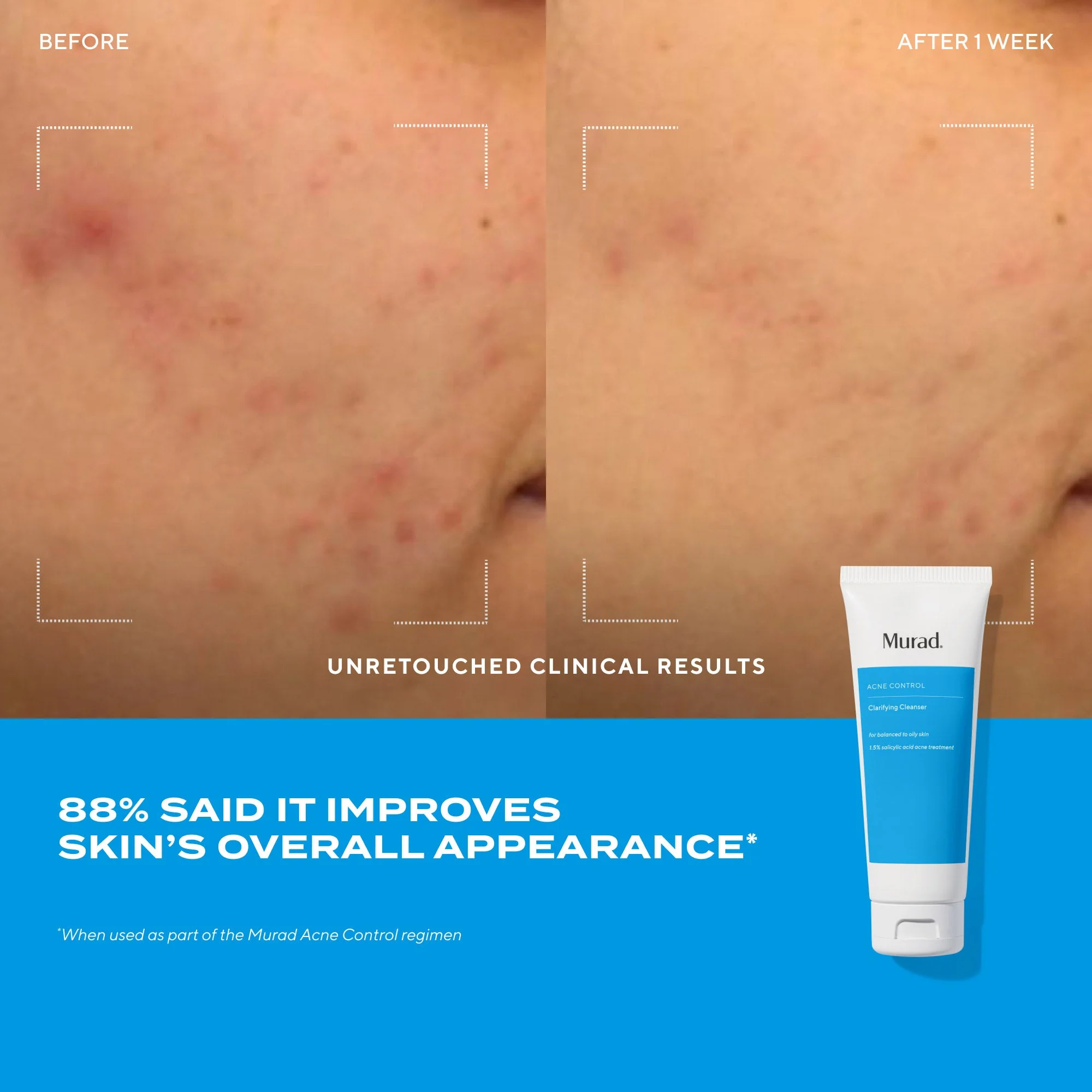 Murad Clarifying Acne Cleanser 5.0 fl oz - Image 5
