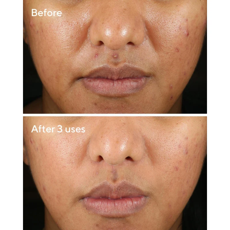 Murad Rapid Relief Acne Sulfur Mask - Image 3